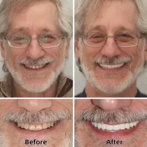 SmileFitPro™–Advanced Custom-Fit Functional Dentures
