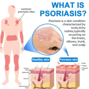 Divifit® Magnesium Herbal Psoriasis Spray