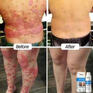 Divifit® Magnesium Herbal Psoriasis Spray